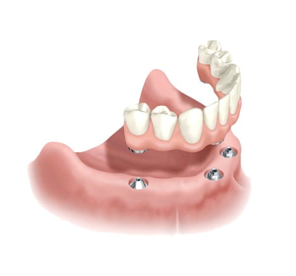dental implants all-on-4