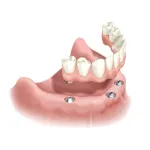 dental implants all-on-4