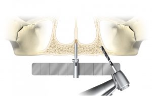 Medical diagram demonstrating guided dental implant surgery, showing a surgical guide stent and a drill placing an implant into the jawbone.