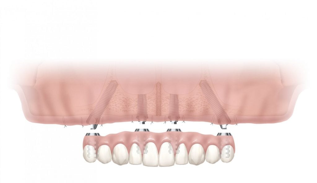 Illustration of a full arch dental implant restoration supported by multiple implants.