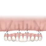 Illustration of a full arch dental implant restoration supported by multiple implants.