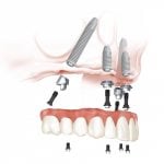 all-on-4 dental implants