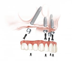 Exploded diagram of an upper jaw full-arch dental implant procedure showing the titanium implants, abutments, and the final prosthetic teeth bridge.